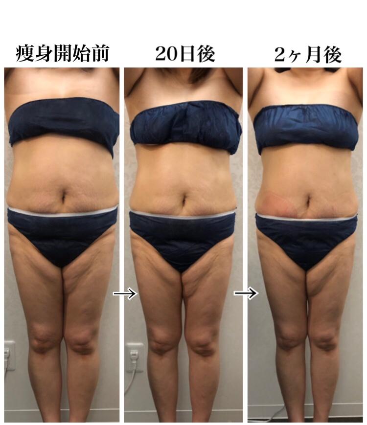 脂肪冷却